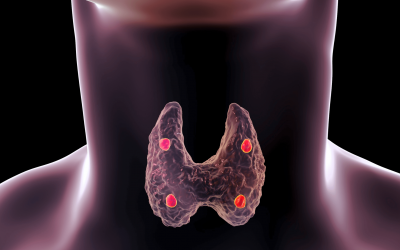 How Long Is Recovery Time After a Thyroidectomy?