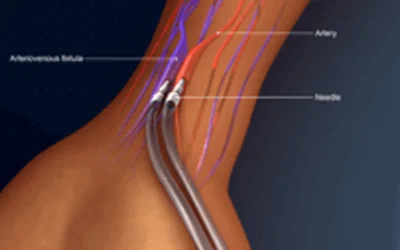 AV Fistula and Grafts