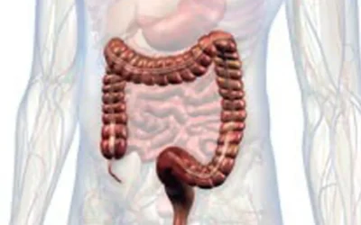 Colon Surgery