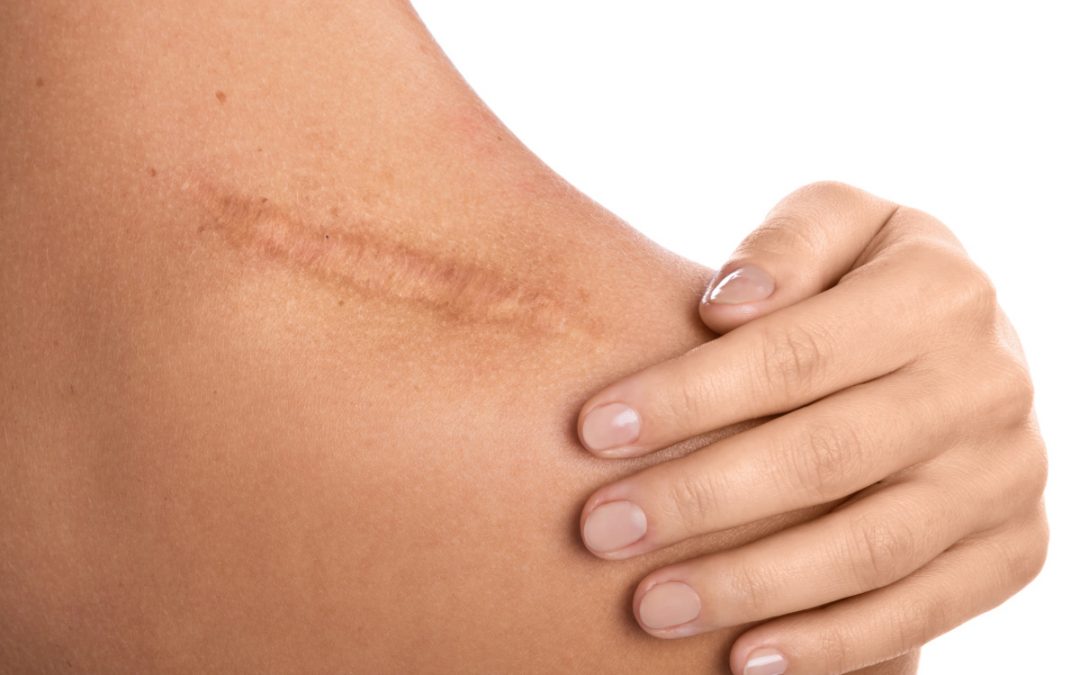 How To Reduce Scar Tissue After Surgery: Best Practices and Treatments